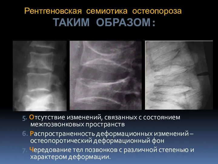 Рентгеновская семиотика остеопороза ТАКИМ ОБРАЗОМ: 5. Отсутствие изменений, связанных с состоянием межпозвонковых