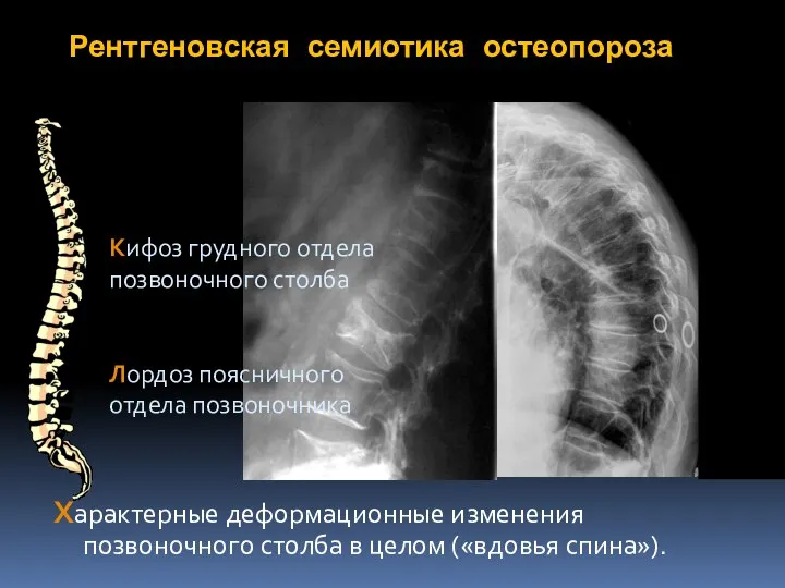 Рентгеновская семиотика остеопороза Характерные деформационные изменения позвоночного столба в целом («вдовья спина»).
