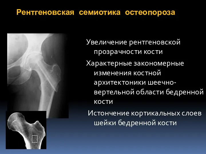 Рентгеновская семиотика остеопороза Увеличение рентгеновской прозрачности кости Характерные закономерные изменения костной архитектоники
