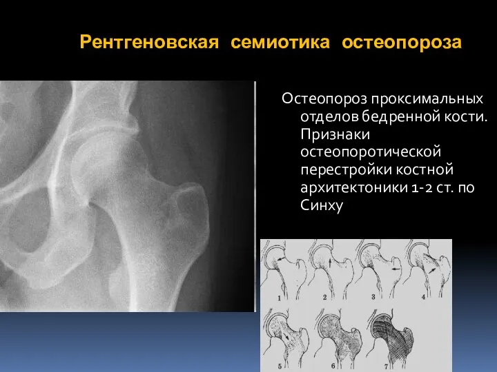Рентгеновская семиотика остеопороза Остеопороз проксимальных отделов бедренной кости. Признаки остеопоротической перестройки костной