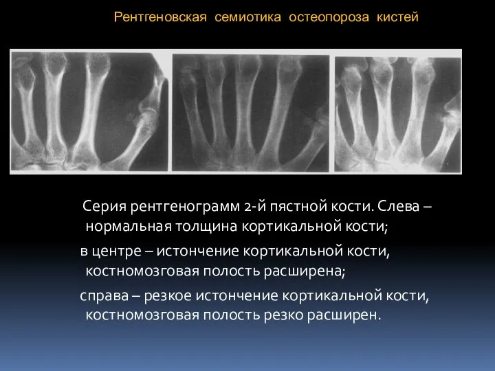 Рентгеновская семиотика остеопороза кистей Серия рентгенограмм 2-й пястной кости. Слева – нормальная