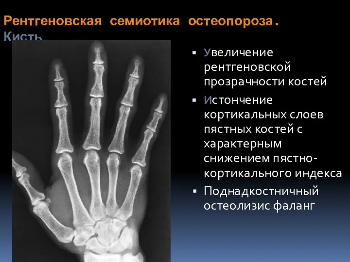 Рентгеновская семиотика остеопороза. Кисть Увеличение рентгеновской прозрачности костей Истончение кортикальных слоев пястных