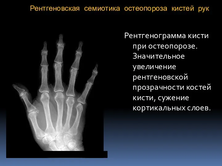 Рентгеновская семиотика остеопороза кистей рук Рентгенограмма кисти при остеопорозе. Значительное увеличение рентгеновской