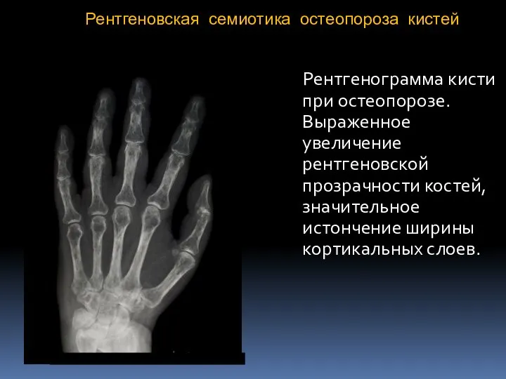 Рентгеновская семиотика остеопороза кистей Рентгенограмма кисти при остеопорозе. Выраженное увеличение рентгеновской прозрачности