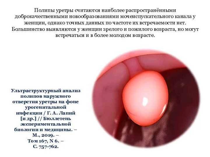 Ультраструктурный анализ полипов наружного отверстия уретры на фоне урогенитальной инфекции / Г.