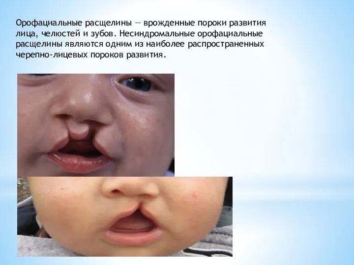 Орофациальные расщелины — врожденные пороки развития лица, челюстей и зубов. Несиндромальные орофациальные