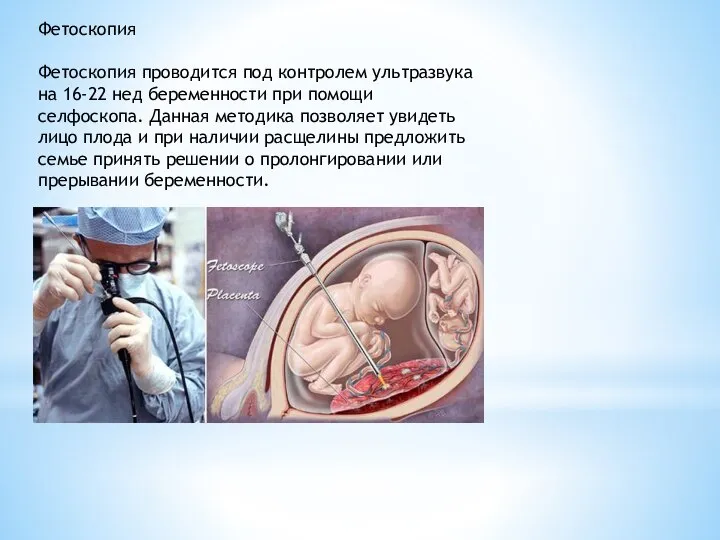 Фетоскопия Фетоскопия проводится под контролем ультразвука на 16-22 нед беременности при помощи