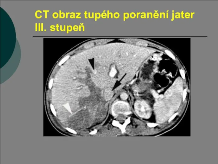 CT obraz tupého poranění jater III. stupeň