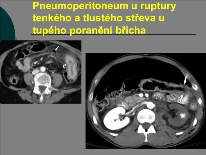 Pneumoperitoneum u ruptury tenkého a tlustého střeva u tupého poranění břicha