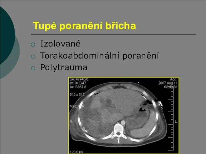 Tupé poranění břicha Izolované Torakoabdominální poranění Polytrauma