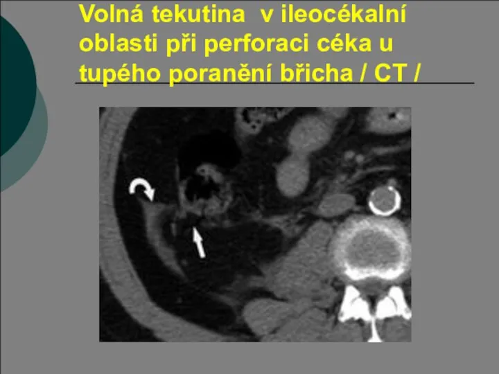 Volná tekutina v ileocékalní oblasti při perforaci céka u tupého poranění břicha / CT /
