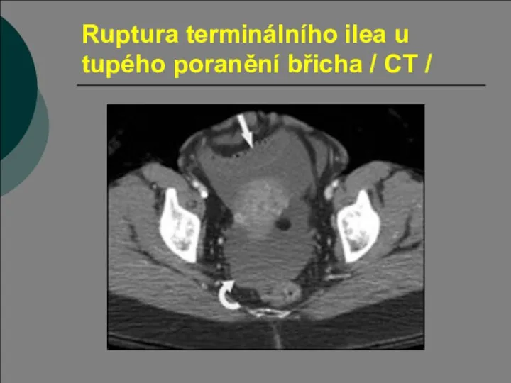 Ruptura terminálního ilea u tupého poranění břicha / CT /