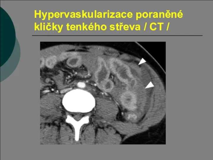 Hypervaskularizace poraněné kličky tenkého střeva / CT /