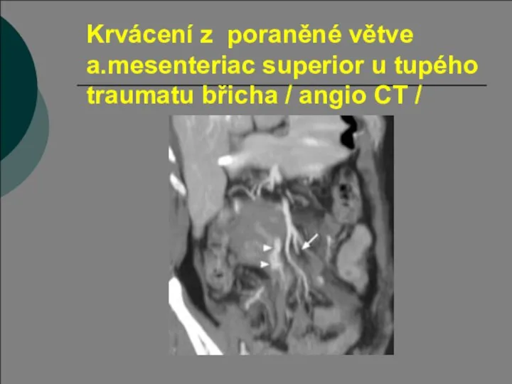Krvácení z poraněné větve a.mesenteriac superior u tupého traumatu břicha / angio CT /