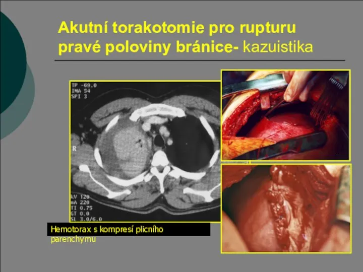 Akutní torakotomie pro rupturu pravé poloviny bránice- kazuistika Hemotorax s kompresí plicního parenchymu