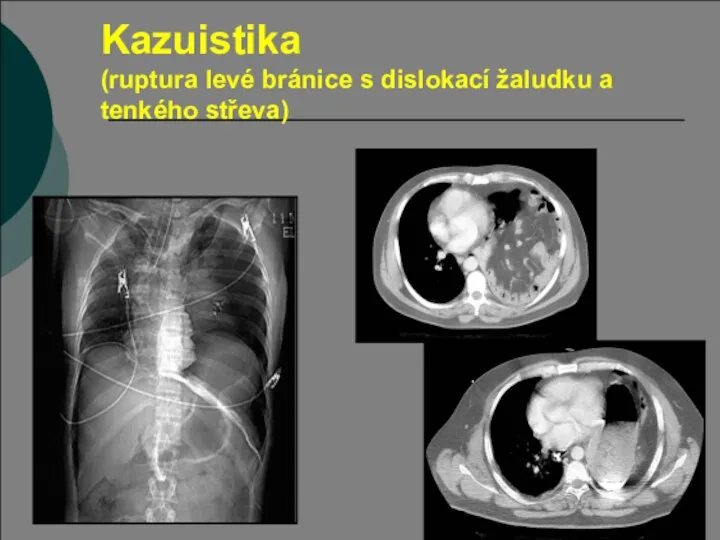Kazuistika (ruptura levé bránice s dislokací žaludku a tenkého střeva)