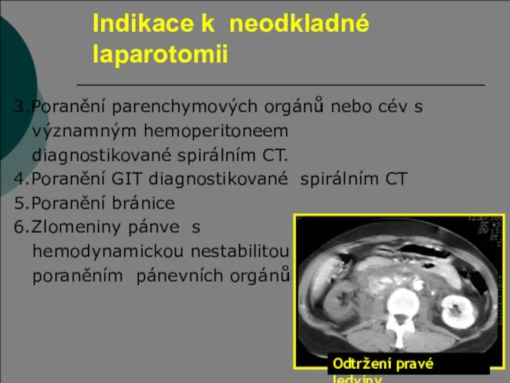 Indikace k neodkladné laparotomii 3.Poranění parenchymových orgánů nebo cév s významným hemoperitoneem