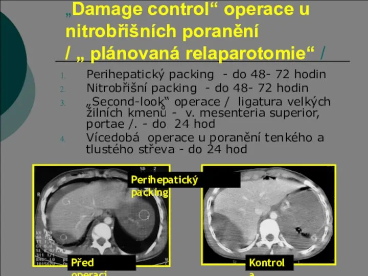 „Damage control“ operace u nitrobřišních poranění / „ plánovaná relaparotomie“ / Perihepatický