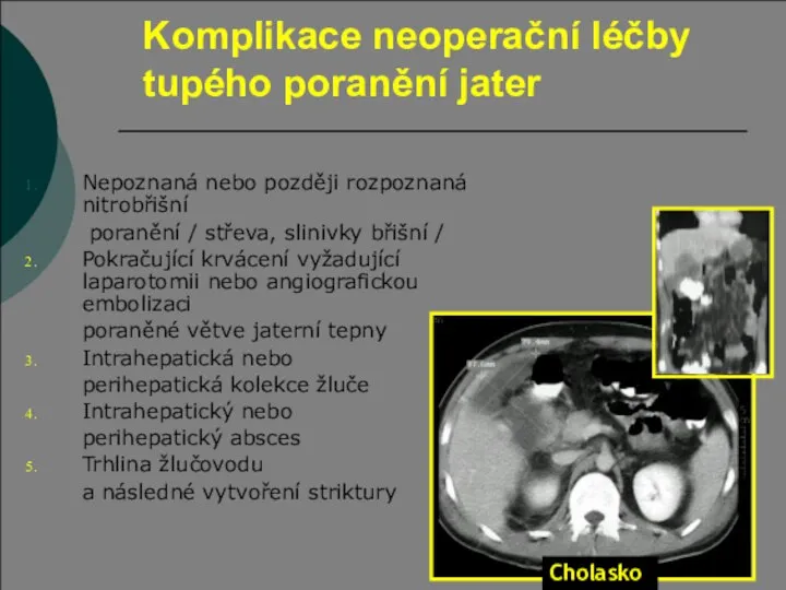 Komplikace neoperační léčby tupého poranění jater Nepoznaná nebo později rozpoznaná nitrobřišní poranění