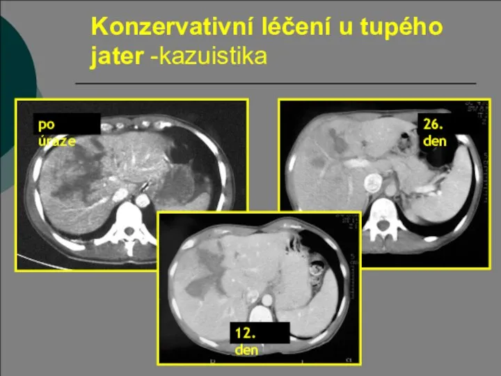 Konzervativní léčení u tupého jater -kazuistika 26. den po úraze 12. den