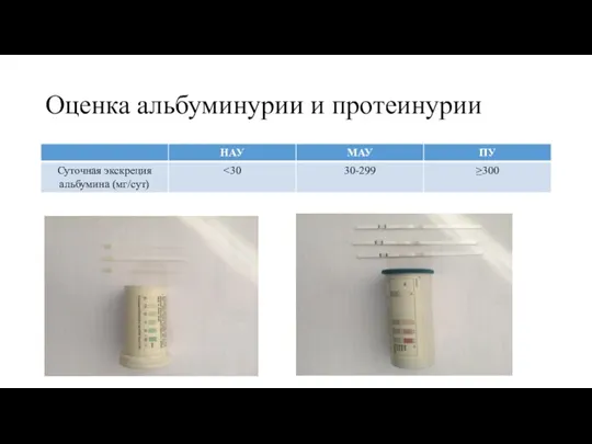 Оценка альбуминурии и протеинурии