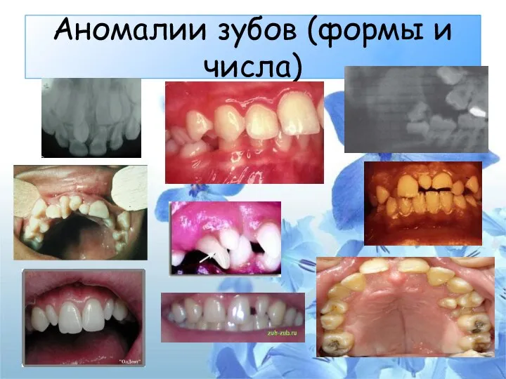 Аномалии зубов (формы и числа)