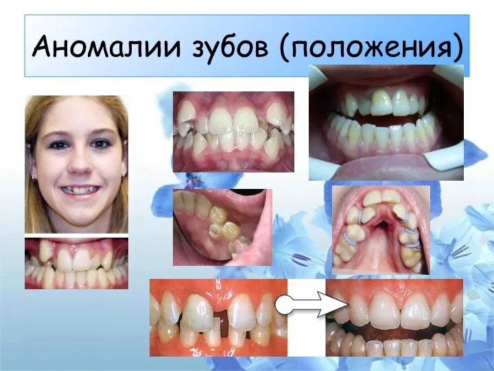 Аномалии зубов (положения)