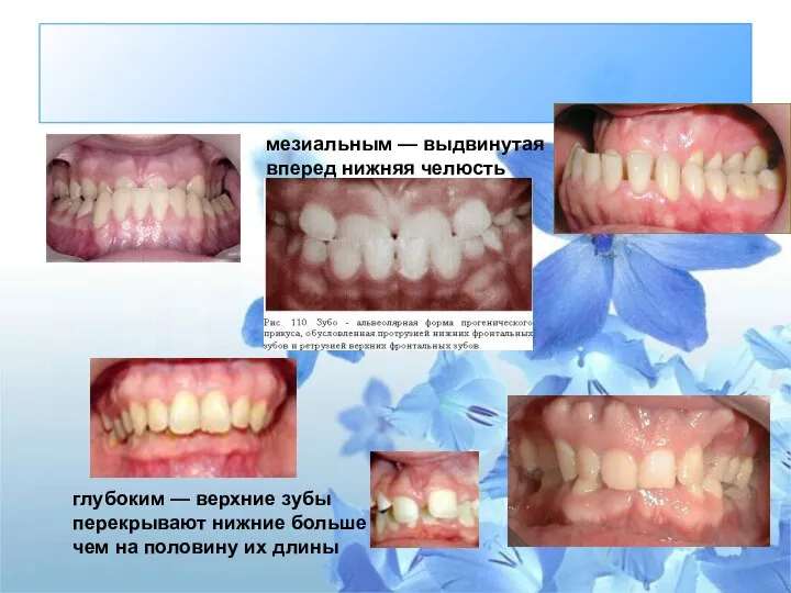 мезиальным — выдвинутая вперед нижняя челюсть глубоким — верхние зубы перекрывают нижние