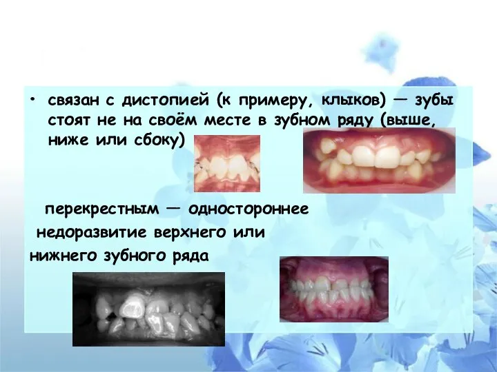 связан с дистопией (к примеру, клыков) — зубы стоят не на своём