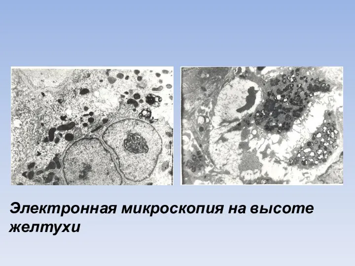 Электронная микроскопия на высоте желтухи