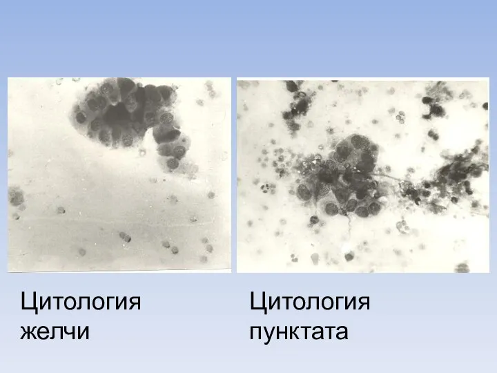 Цитология желчи Цитология пунктата