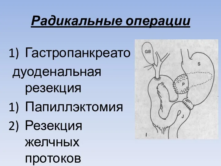 Радикальные операции Гастропанкреато дуоденальная резекция Папиллэктомия Резекция желчных протоков