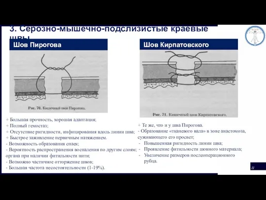 3. Серозно-мышечно-подслизистые краевые швы Шов Пирогова Шов Кирпатовского + Большая прочность, хорошая