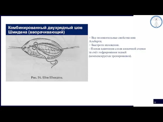 Комбинированный двухрядный шов Шмидена (вворачивающий) + Все положительные свойства шва Альберта; +