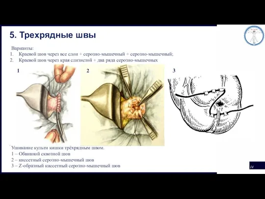 5. Трехрядные швы Варианты: Краевой шов через все слои + серозно-мышечный +