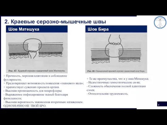 2. Краевые серозно-мышечные швы Шов Матешука Шов Бира + Прочность, хорошая адаптация