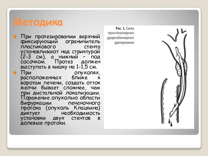Методика При протезировании верхний фиксирующий ограничитель пластикового стента устанавливают над стриктурой (2-3
