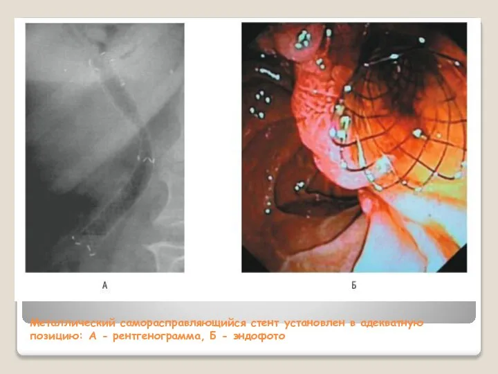 Металлический саморасправляющийся стент установлен в адекватную позицию: А - рентгенограмма, Б - эндофото