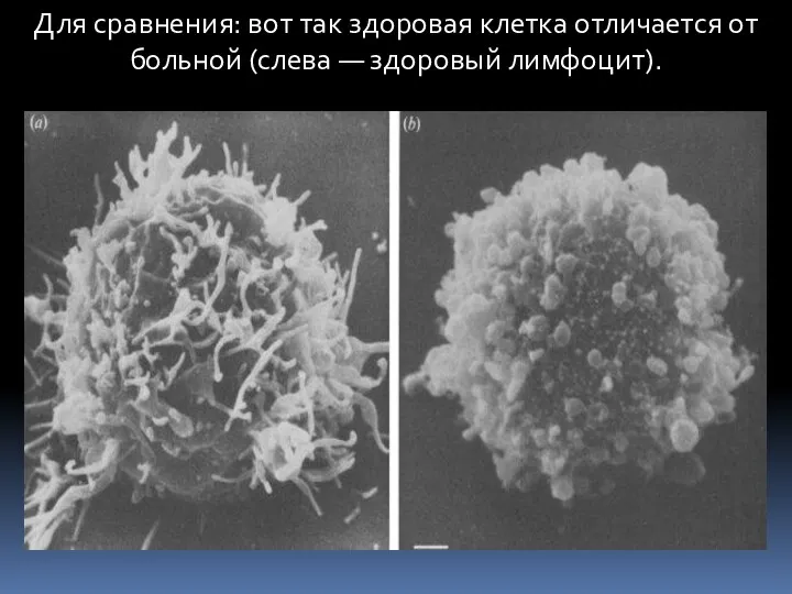 Для сравнения: вот так здоровая клетка отличается от больной (слева — здоровый лимфоцит).