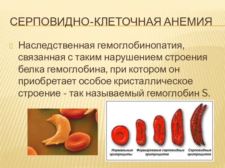 СЕРПОВИДНО-КЛЕТОЧНАЯ АНЕМИЯ Наследственная гемоглобинопатия, связанная с таким нарушением строения белка гемоглобина, при