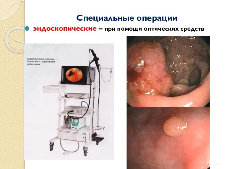 Специальные операции эндоскопические – при помощи оптических средств