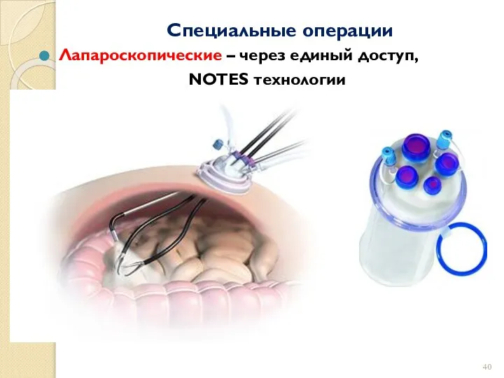 Специальные операции Лапароскопические – через единый доступ, NOTES технологии