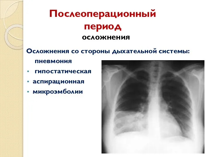 Послеоперационный период осложнения Осложнения со стороны дыхательной системы: пневмония гипостатическая аспирационная микроэмболии