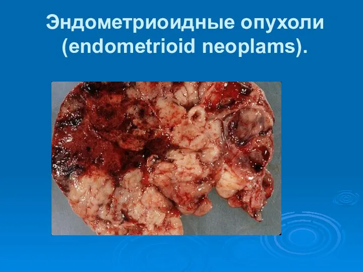 Эндометриоидные опухоли (еndometrioid neoplams).