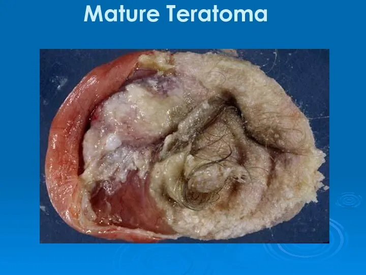 Mature Teratoma