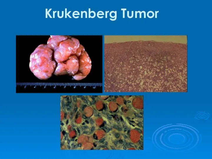 Krukenberg Tumor