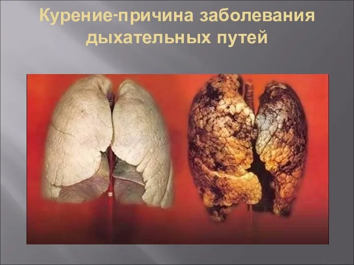 Курение-причина заболевания дыхательных путей