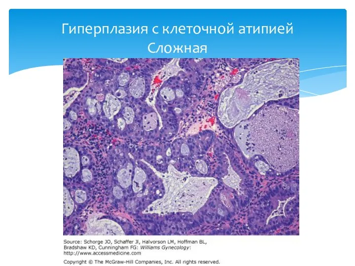 Гиперплазия с клеточной атипией Сложная