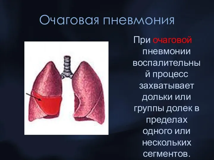 Очаговая пневмония При очаговой пневмонии воспалительный процесс захватывает дольки или группы долек