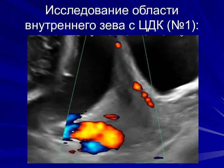 Исследование области внутреннего зева с ЦДК (№1):